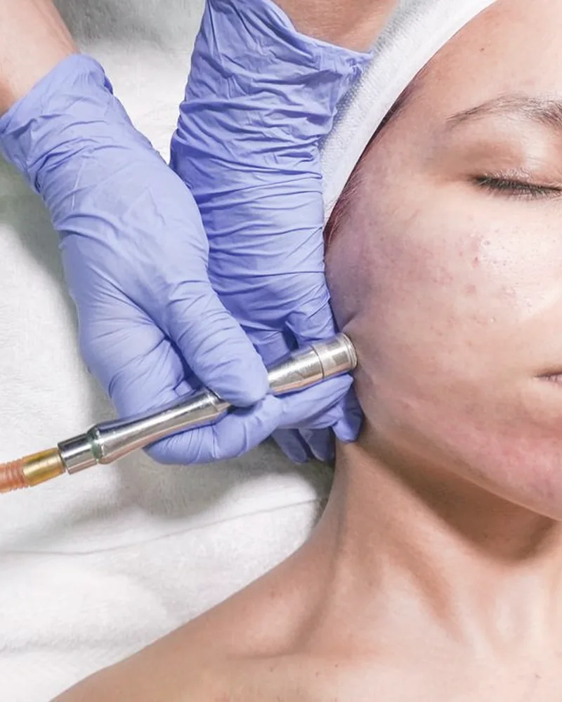 Microneedling treatment with a professional device